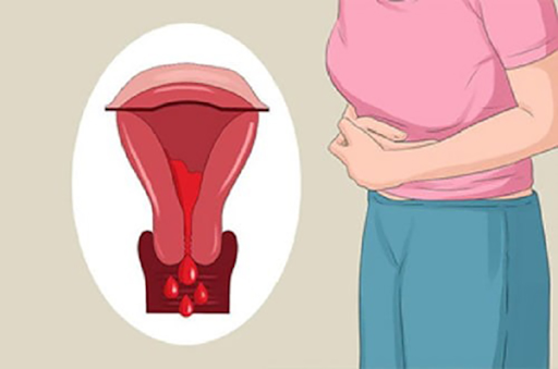 Chảy máu nhiều ở vùng âm đạo là biến chứng thường gặp của u xơ tử cung 
